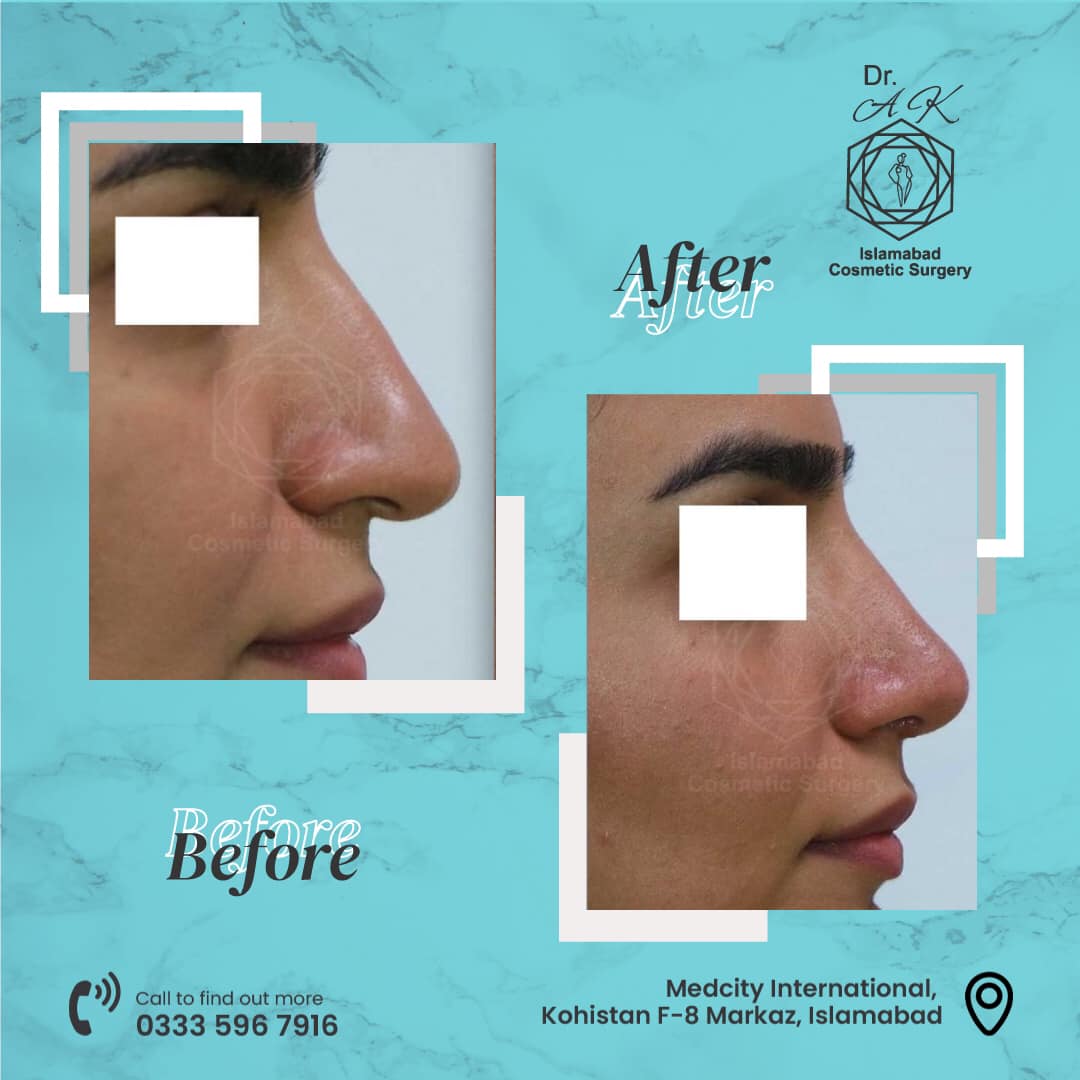 Top Benefits of Choosing a Plastic Surgeon in Islamabad for Cosmetic Procedures